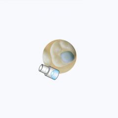 Posterior Molar Pad Mini-Mold Tips